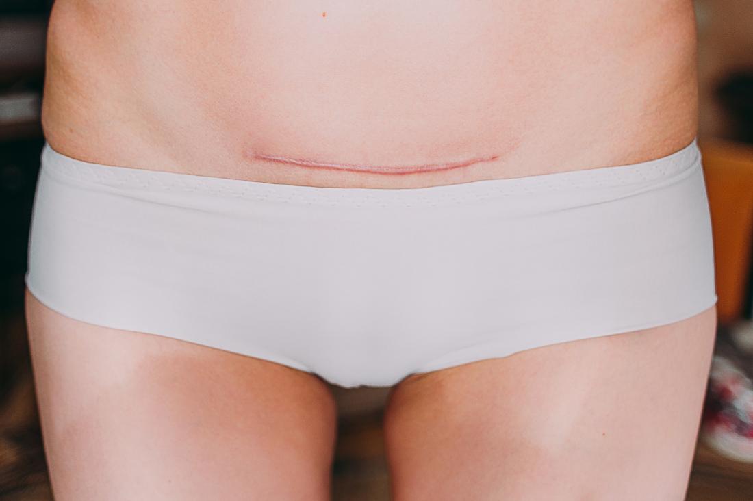How Long Should You Wear An Abdominal Binder After C-Section